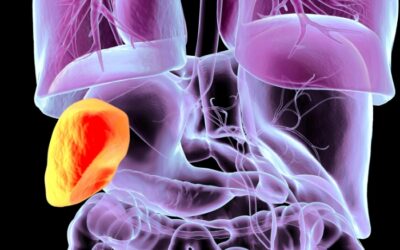 Bacterial Overgrowth Diet: What to Eat, What to Avoid & How to Improve Digestion