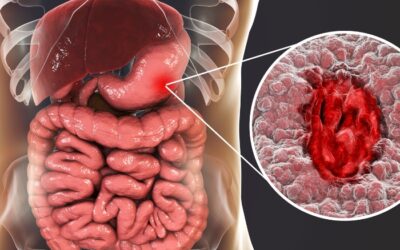 What Are the Symptoms of Stomach Ulcers? Digestive Health Guide