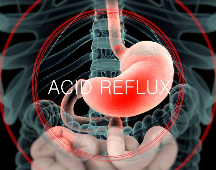 healthy foods causing acid reflux Why You Get Acid Reflux Even When Eating Healthy