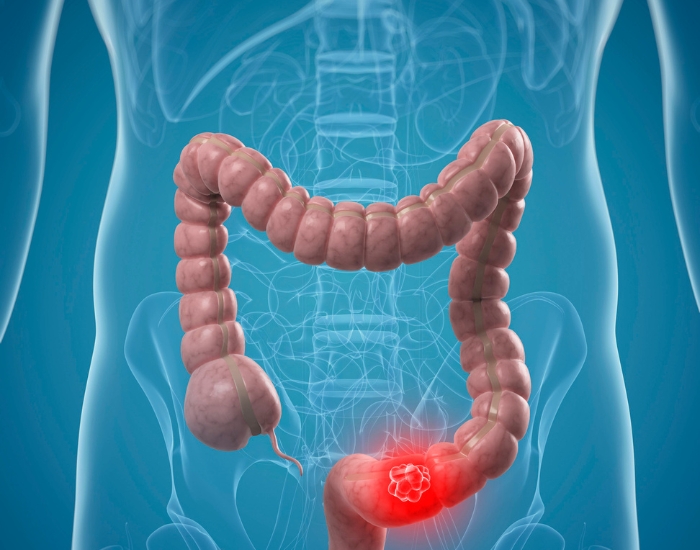 early colon cancer signs