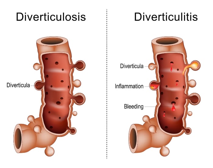 what is the difference between diverticulitis and diverticulosis