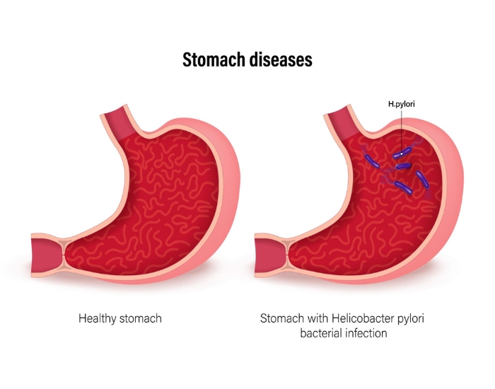 what are the symptoms of h pylori