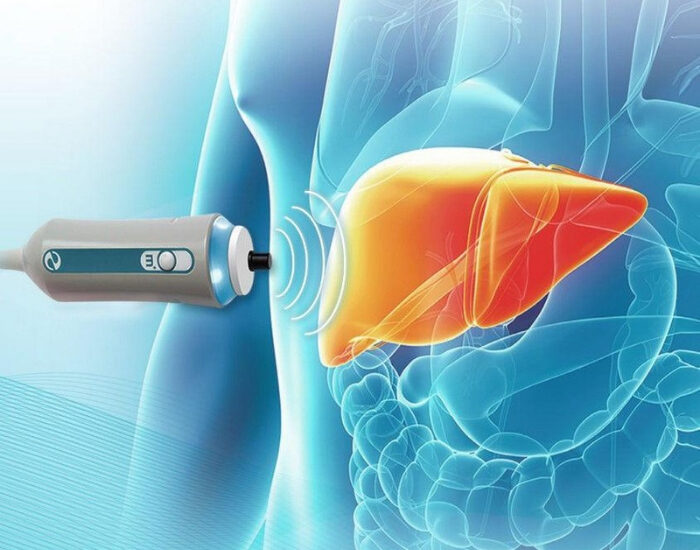 FibroScan probe measuring liver stiffness, illustration