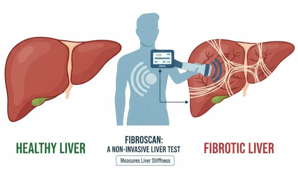 liver fibrosis test