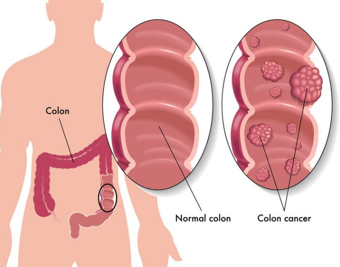 symptoms of bowel cancer
