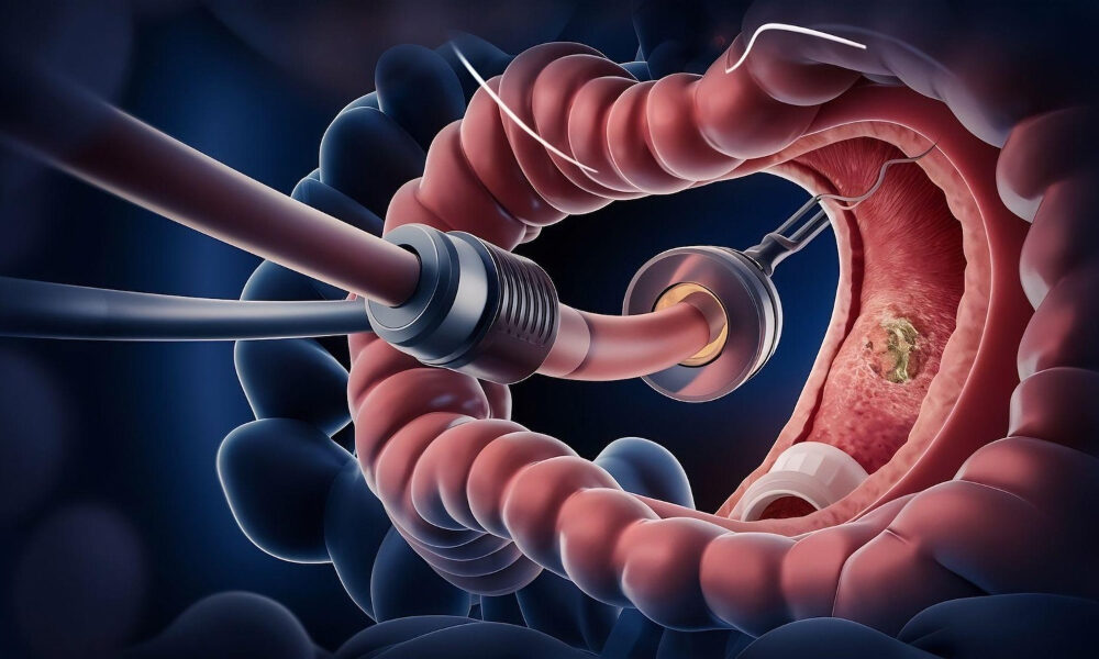early symptoms of colon cancer