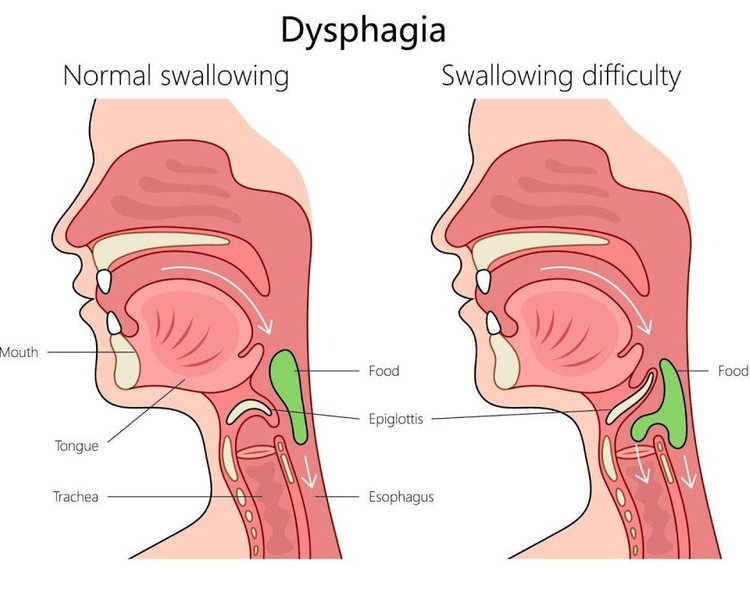 difficulty swallowing doctor why is it hard to swallow food