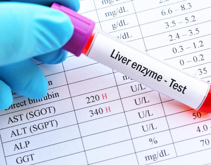 elevated liver enzymes