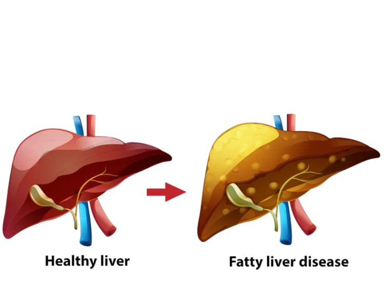fatty liver specialist why is it hard to swallow food