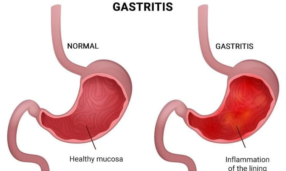 Diagram of a normal stomach lining compared with gastritis inflammation