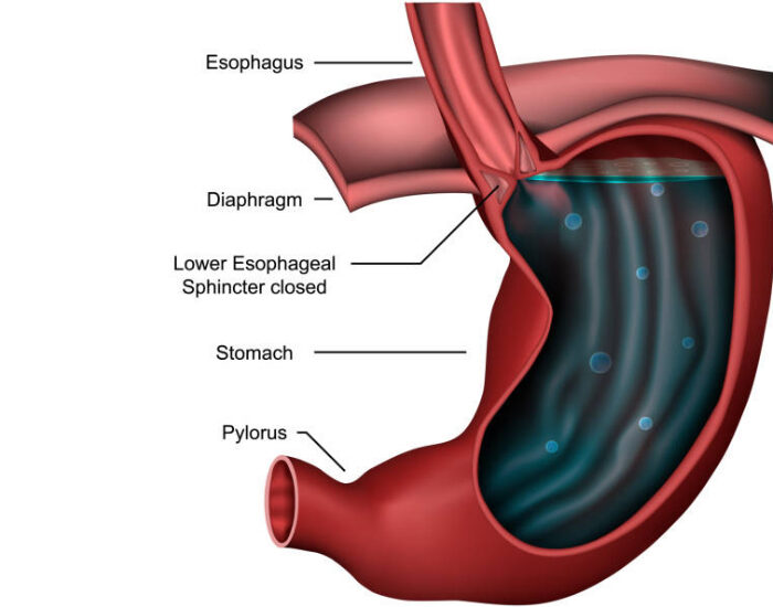 when should I see a specialist for acid reflux