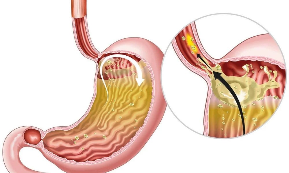 Illustration of stomach acid rising into the esophagus