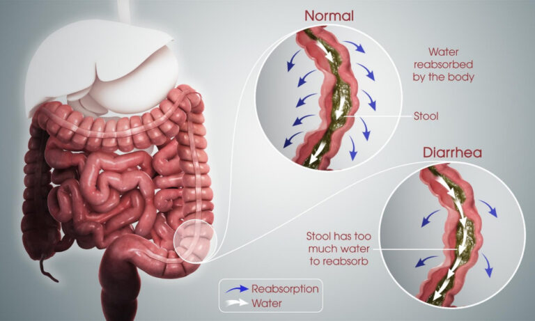 Patient with diarrhea after gallbladder removal talking to a doctor